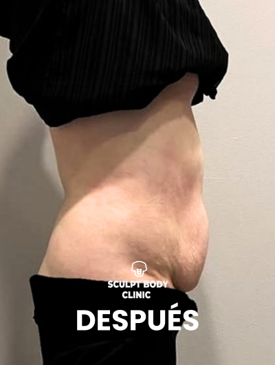 Después 1