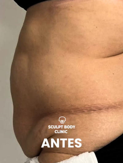 Antes 2
