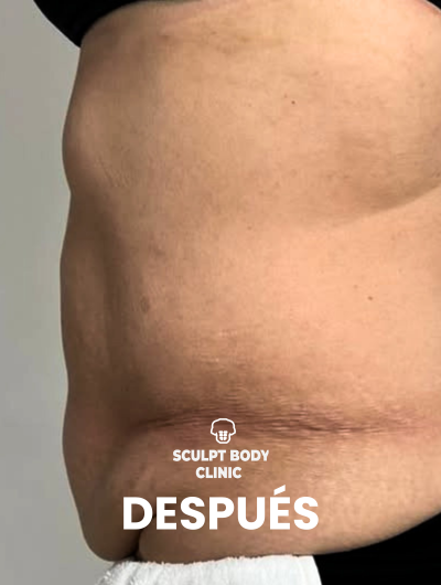 Después 2