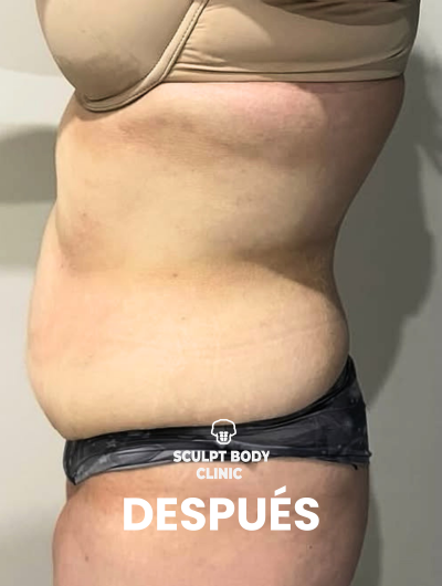 Después 3